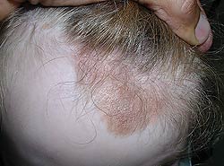 A melanocytic congenital nevus on her scalp and forehead with overlying desquamated plaques and subtle erythema