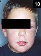 Figure 10: The same patient with poison ivy after a few days of systemic steroids and no antibiotics