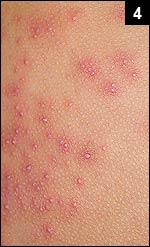 Figure 4: The skin over both hips revealed numerous pustules overlying somewhat raised erythematous bases