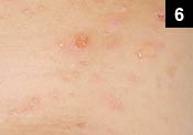 Figure 6: Bullous impetigo is a superficial S. aureus infection of the skin that results in vesicles or small blisters