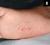 Figure 8: Contact dermatitis virtually always has an inflammatory component to it and may have some blistering as well