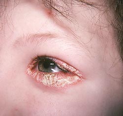 Eyelid dermatitis