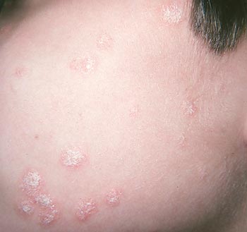 Psoriasis