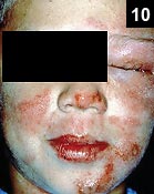 Figure 10: Severe cellulitis