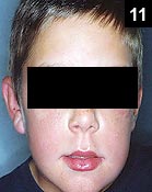 Figure 11: Patient with severe cellulitis several days later