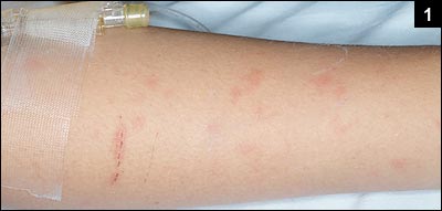 Figure 1: A petechial rash, mixed with maculopapular lesions