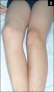 Figure 2: A petechial rash, mixed with maculopapular lesions