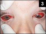 Figure 3: Marked erythema of eyes