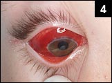 Figure 4: Marked erythema of eyes