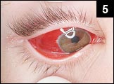 Figure 5: Marked erythema of eyes