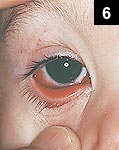 Figure 6: A similar illness might be seen with adenovirus infections