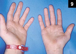 Figure 9: Rhus dermatitis, a rash caused by contact with the oil