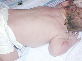 The skin examination reveals multiple scattered erosions, vesicles and crusted papules