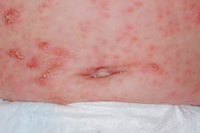 Small erythematous papules on the chest, axillae, abdomen and extremities