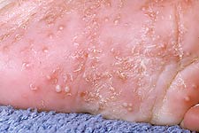 Scabies is caused by the mite