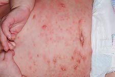 Lesions appear as pinpoint papules and discrete vesicles