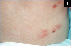 Figure 1: A 12-day-old male neonate was admitted to the hospital for evaluation and treatment of a rash