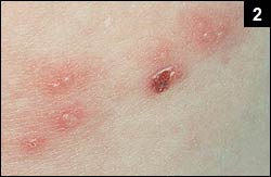 Figure 2: Lesions with vesicles on erythematous bases