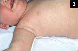 Figure 3: A generalized maculopapular rash involving the face and trunk