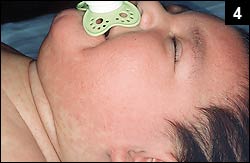 Figure 4: A generalized maculopapular rash involving the face and trunk