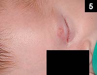 Figure 5: The face is a common site for this problem to occur in neonates