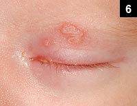 Figure 6: The face is a common site for this problem to occur in neonates