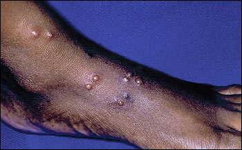 Several grouped and linear 3 mm to 6 mm vesicles and one discrete 2 mm hyperpigmented excoriated papule extending to the right ankle