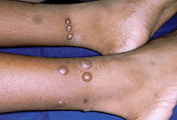 Bullous papular urticaria or insect bite-induced hypersensitivity