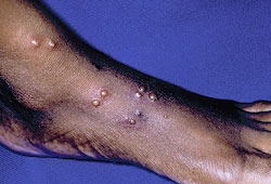 Bullous papular urticaria or insect bite-induced hypersensitivity