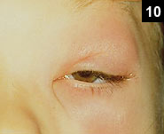 Figure 10: A severe bacterial infection of the eye