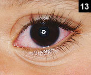 Figure 13: Kawasaki disease has a nonexudative conjunctivitis as a criteria