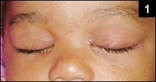 Figure 1: Mild, painless swelling of her left eye lid