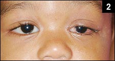 Figure 2: Mild, painless swelling of her left eye lid