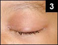 Figure 3: The left eye also is erythematous with a small amount of discharge