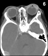 Figure 6: A computed tomography scan of the orbits