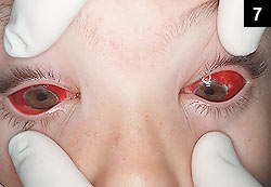 Figure 7: Enteroviral hemorrhagic conjunctivitis