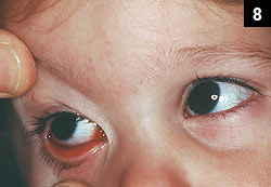 Figure 8: Eye irritation caused by adenovirus