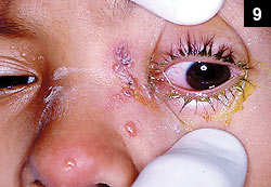 Figure 9: Eye irritation caused by varicella zoster