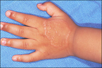 A skin colored annular plaque on the patient's right arm