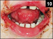 Figure 10: Herpes simplex infection