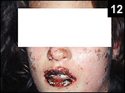 Figure 12: SJS is an acute inflammatory condition