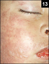 Figure 13: Fluid-filled lesions