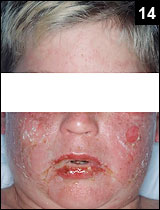 Figure 14: The skin lesions may be larger to more Bullous-like