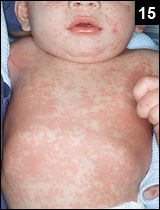 Figure 15: Kawasaki Disease (KD) commonly has a polymorphous rash