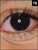 Figure 16: Kawasaki Disease will likely have non-exudative conjunctivitis