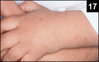 Figure 17: Swelling of the hands