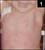 Figure 1: Maculopapular rash with a general distribution, containing numerous annular lesions