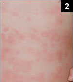 Figure 2: Maculopapular rash with a general distribution, containing numerous annular lesions