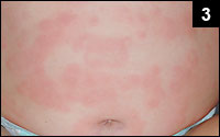 Figure 3: Maculopapular rash with a general distribution, containing numerous annular lesions