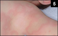 Figure 5: Maculopapular rash with a general distribution, containing numerous annular lesions